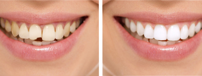 Можно-ли восстановить зуб еслиСложное восстановление зубов.