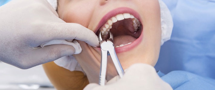 Когда показано удаление зубов
