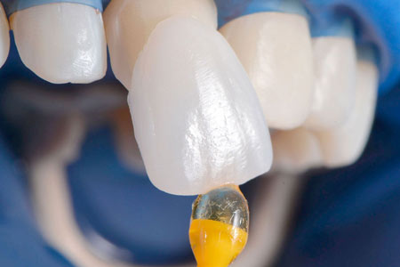 Как происходит реставрация зубов винирами